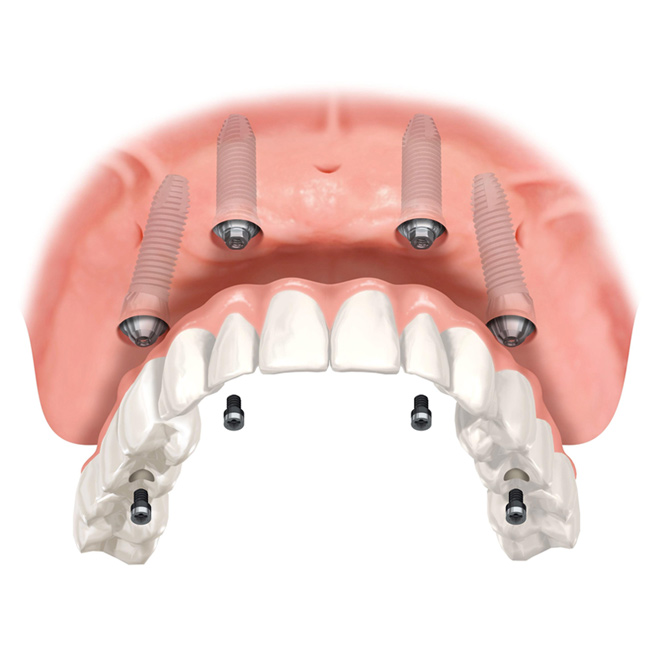 IMPLANTOLOGIA ALL ON FOUR