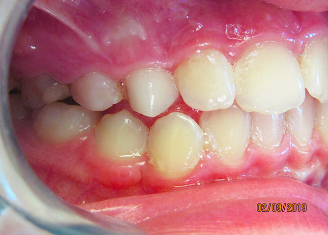 Studio Dentistico Marina Fiocca - Caso ortodonzia intercettiva