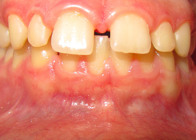 Studio Dentistico Marina Fiocca - Caso ortodonzia trasparente