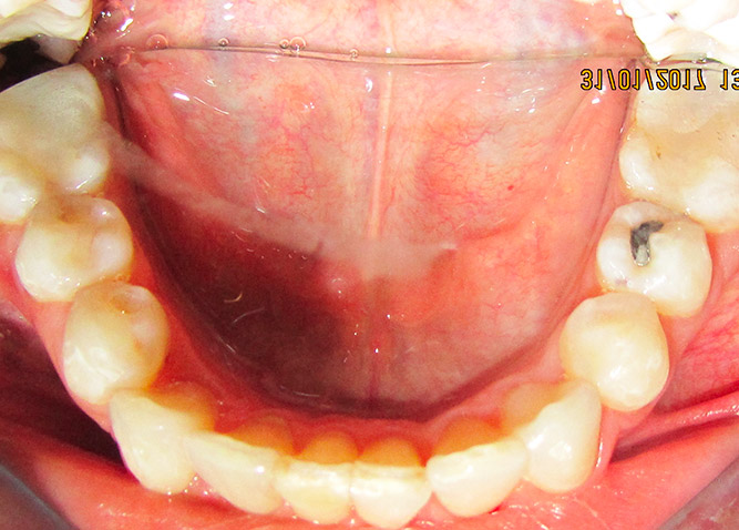Studio Dentistico Marina Fiocca - Caso ortodonzia trasparente