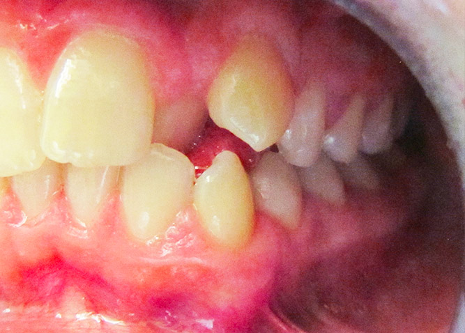 Studio Dentistico Marina Fiocca - Caso ortodonzia