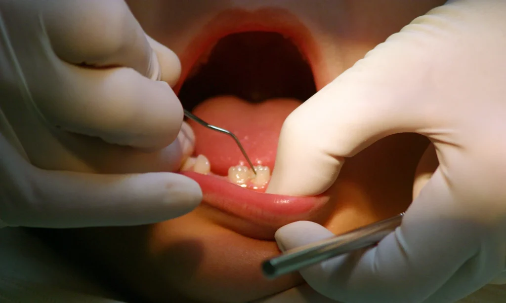 Frenulectomia dentale